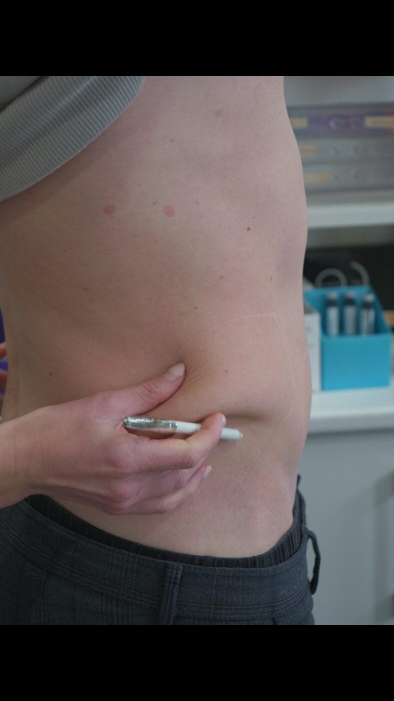 Body sculpting area assessment at Dawn Clinic