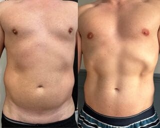 Before and after EM Body Sculpt muscle toning results at Dawn Clinic, Penarth