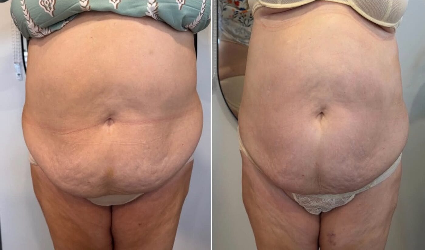Before and after body contouring results at Dawn Clinic, Penarth