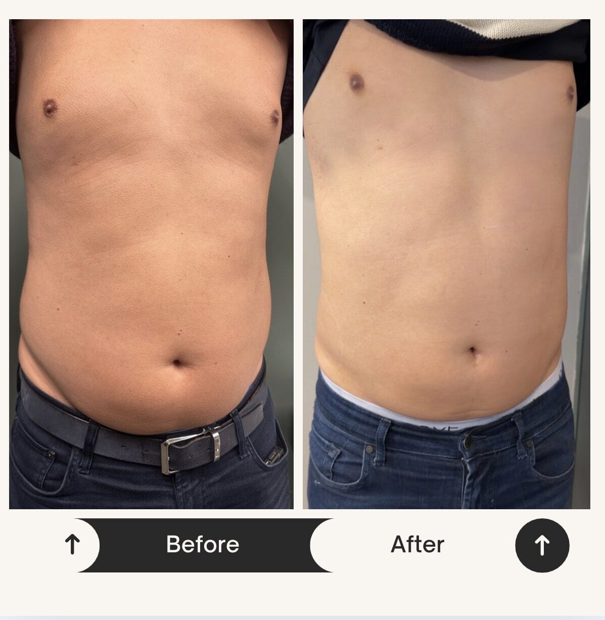 Before and after body sculpting results at Dawn Clinic, Penarth