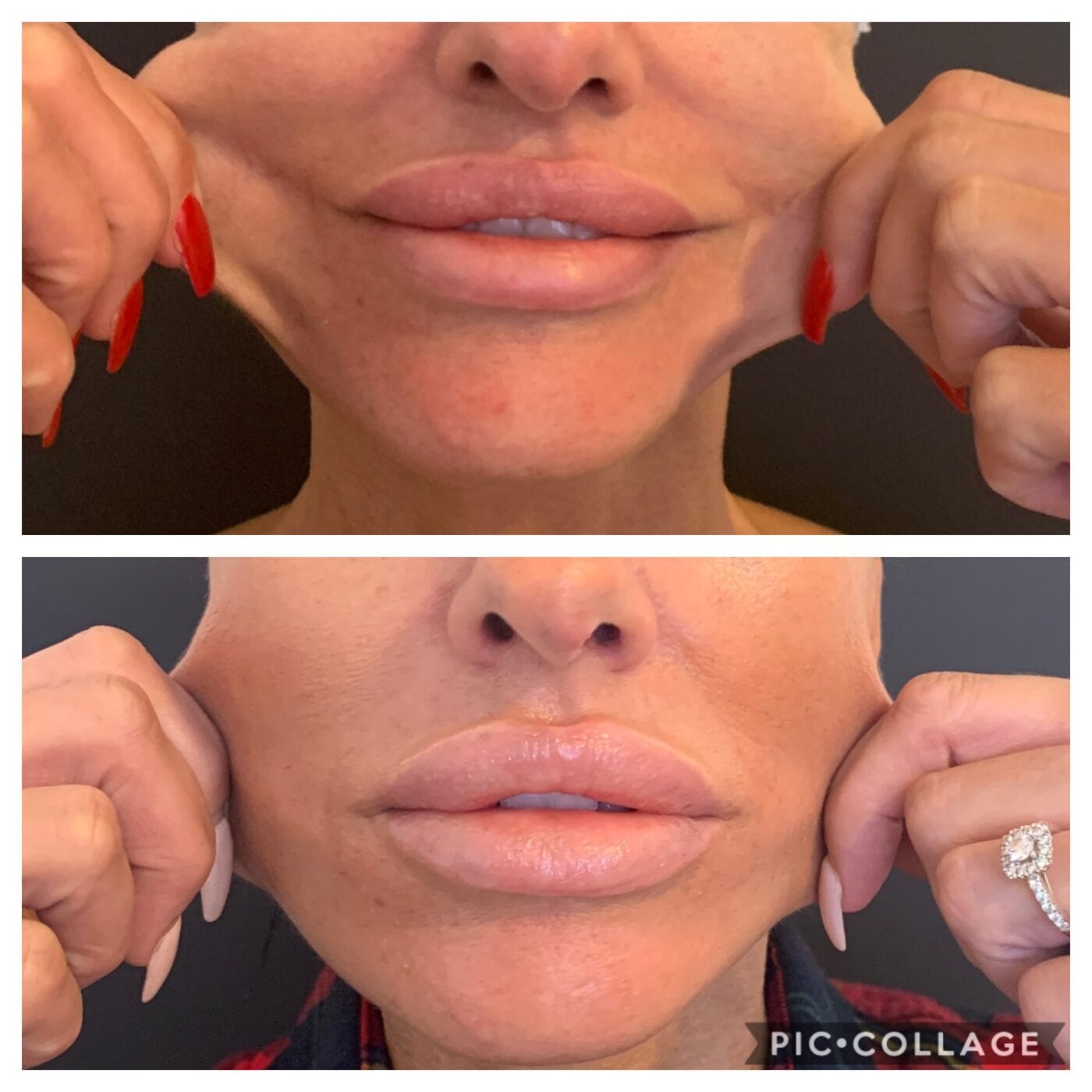 Before and after jawline definition following Sculptra treatment at Dawn Clinic, Penarth