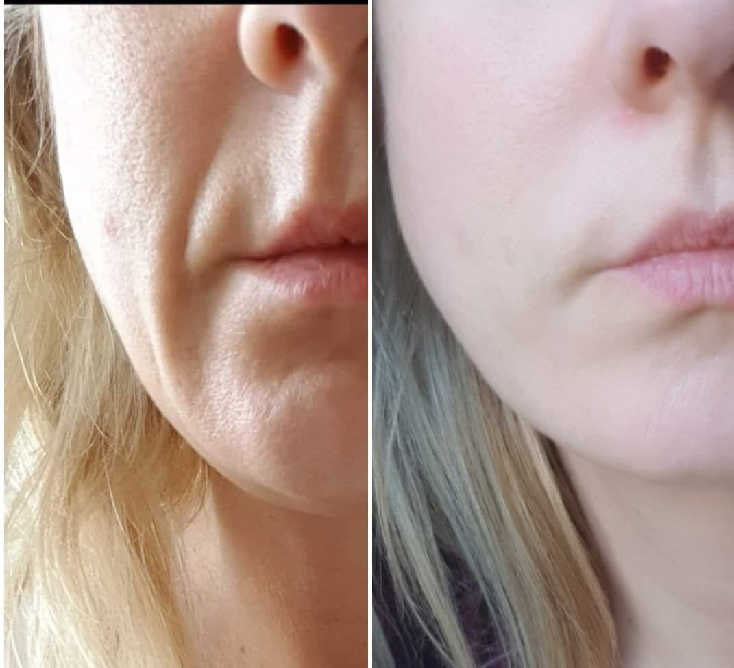 Before and after jawline and marionette line improvement following Sculptra treatment at Dawn Clinic, Penarth