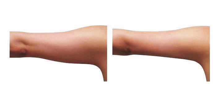 image-059 Body Sculpting Cardiff