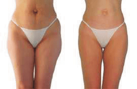 image-060 Body Sculpting Cardiff